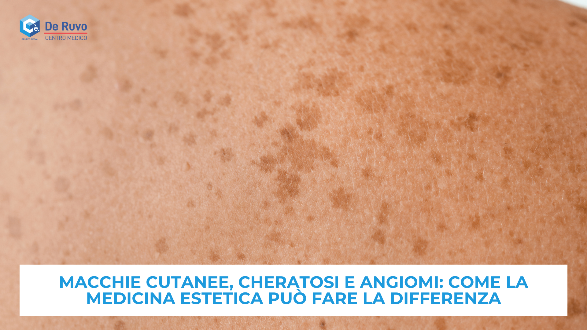 Macchie cutanee, cheratosi e angiomi: come la medicina estetica può fare la differenza